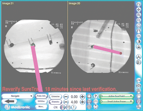 Figure 6. A screenshot of the surgical navigation system displaying the location of the metal detector. This visual guidance is supplemented by the audio indications heard by the surgeon.