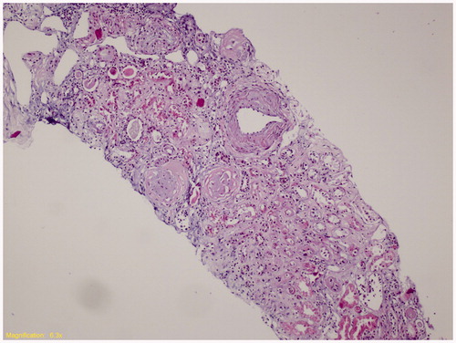 Figure 1. Kidney biopsy specimen of index Case 1. (Representative histological section hematoxylin and eosin stain, ×100; Tubular thyroidization, glomerular global sclerosis, interstitial chronic inflammation, arterial medial thickening was observed. Vacuolization of the glomerular tuft and tubular cells was not detected.)