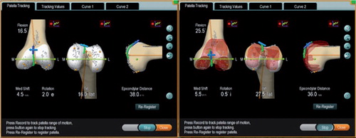 Figure 2. Screenshot of patellar tracking in the arthritic knee (left panel) and after TKA (right panel).