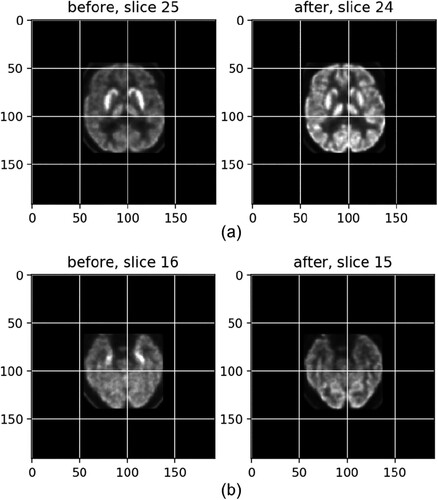 Figure 7. The normalization (a) and registration (b) images before and after treatment, with the posterior cortex used as the reference.
