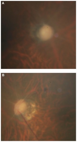 Figure 3 Optic disc appearance about 3 months after radiofrequency radiation injury. Diffuse optic disc pallor is shown in both eyes with (A) resolving right optic disc swelling and (B) marked arteriolar attenuation.