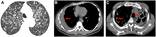 Figure 4 Type of TB. (A) CT showed pia miliary tuberculosis in both lungs. (B) CT showed marked pleural thickening at the right side (arrows). (C) CT showed bilateral pleural thickening and adhesion.