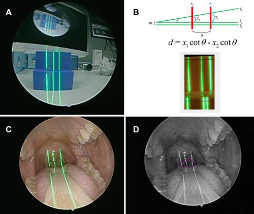 Figure 3 (A) The laser beams projected on the testing sample. (B) With a specially designed angle laser line, the depth can be calculated by our module (θ=8.5 degrees). (C) The laser beams projected on the subject to determine the maximum cross-sectional area of the oropharyngeal inlet. (D) The retropalatal depth and the cross-sectional area were determined and calculated automatically.