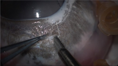 Figure 6 8K UHD image in creating a sclera flap of pig cadaver eye.