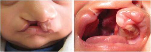 Figure 1. Unilateral right-sided cleft lip and palate.