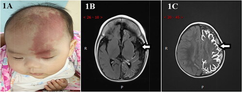 Figure 1. (A) The infant’s left forehead and upper eyelid were wine colored, which was light red and smooth. (B) The sulci and fissure of the bilateral cerebral hemispheres were widened and deepened, and the gyri were narrowed. The left cerebral hemisphere was more evidently atrophied than the right, and bilateral lateral ventricles and third ventricles were widened. (C) Diffuse gyri-like enhancement was observed on the brain surface of the left cerebral hemisphere, and linear enhancement was observed on the brain surface of the right parietal lobe.