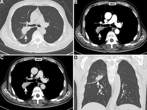 Figure 4 Enhanced computed tomography findings of the chest after chemotherapy (white arrow). A significant decrease in the size of the lesions in plain chest CT (A), arterial phase (B), venous phase (C), and coronal sections (D).