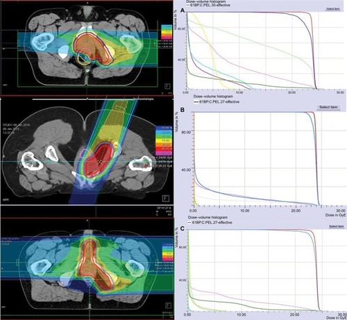 Figure 1 Dose distribution and dose–volume histogram of boost plans with a carbon ion total dose of 24 GyE (RBE); isodoses in percent. (A) Case 1; (B) case 2; (C) case 3.Abbreviations: RBE, relative biological effectiveness; GyE, Gray equivalents.