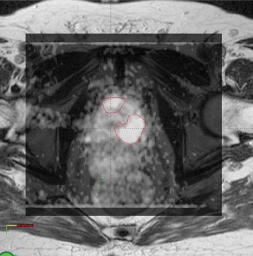 Figure 1. DWI superimposed to T2WI for a patient with two DILs in peripheral zone.