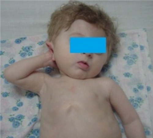 Figure 1 Newborn with triangle face.