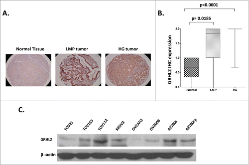 Figure 1. Analysis of GRHL2 expression in serous EOC tumors by IHC. A. Representative IHC images of GRHL2 protein expression in normal ovarian tissues, low-malignant potential (LMP) tumors and high-grade (HG) tumors. B. Box-plot presentation of GRHL2 protein expression levels in normal ovarian tissues, LMP tumors and HG tumors. C. Western-blot analysis of endogenous GRHL2 protein expression in different EOC cell lines.