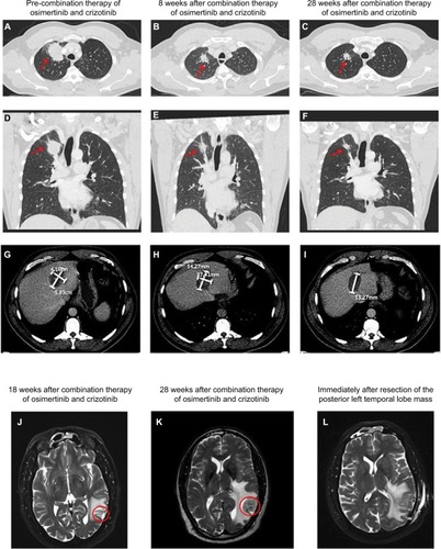 Figure 2 CT images showing the right apex lung mass before (A & D), 8 weeks after (B & E), and 28 weeks after (C & F) combination therapy of osimertinib and crizotinib. The red arrows indicate the right apex lung mass seen on the axial view (A–C) as well as the coronal view (D–F). CT images showing a hepatic mass before (G), 8 weeks after (H), and 28 weeks after (I) combination therapy of osimertinib and crizotinib. This patient also received microwave ablation of this hepatic mass prior to initiation of the combination therapy. MRI images showing the posterior left temporal lobe mass 18 weeks after (J) and 28 weeks after (K) combination therapy of osimertinib and crizotinib. The red circles clearly indicate disease progression at 28 weeks as demonstrated by the interval increase in size of the mass. Of note, this mass had previously received stereotactic radiation. The patient subsequently underwent total resection of the mass (L).