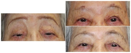 Figure 3 A 76-year-old woman with congenital ptosis in both eyes.