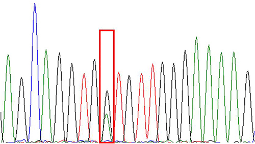 Figure 10 NRAS-Ex2c.38G>A (p.G13D).