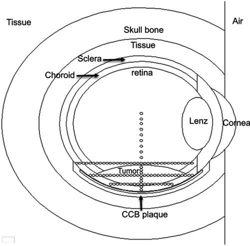 Figure 2 Eye geometry defined in the MCNPX simulation code and CCB applicator sewn on the sclera.