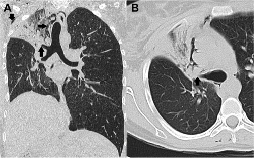 Figure 6 Coronal and axial reformatted CT scan images of the chest.