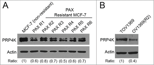 Figure 4. PRP4K expression is decreased in cells that have an acquired resistance to taxanes. (A) MCF-7 human breast cancer cells were exposed to a sub-lethal concentration of paclitaxel for 3 weeks. The concentration of paclitaxel in the growth media was tripled every 3 weeks for 15 weeks to create a resistant population. Individual clones were isolated from the resistant population, and analyzed via Western blot for PRP4K protein level. (B) TOV1369 and OV1369(R2) cell lines were isolated from an ovarian cancer patient pre-taxane treatment, and post-relapse, respectively. Whole cell lysates were prepared from each cell line and PRP4K protein levels were determined via Western blot. Band intensity was quantified by densitometry and represented as ratios.