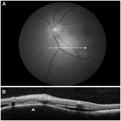 FIGURE 1. Spectral domain optical coherence scan passing through the large juxtapapillary yellowish lesion (A, red free frame) shows a dome-shape appearance of the overlaying retina (arrowhead) and subretinal fluid accumulated on either sides of the lesion (B).