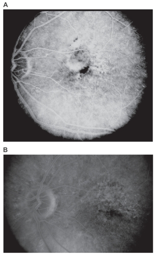 Figure 1 Pre-and post-treatment fluorescein angiogram (FA) of the left eye of a patient with AMD-related predominantly classic SFCNV. A) Pre-treatment, late phase frame. B) Ten months after two sessions of PDT, late phase frame. Note absence of CNV leakage in the post-treatment angiogram.