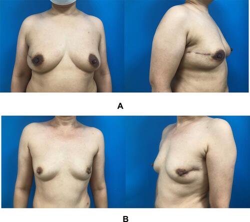 Figure 2 Comparison of aesthetic effect. (A) BCS combined with immediate AFG. (B) BCS. Through these two sets of pictures, we could see the advantages of AFG in protecting the appearance of breast.