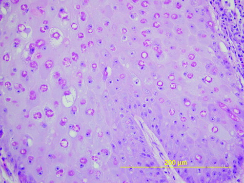 Figure 3.  Pox-infected epithelium illustrating hyperplasia, cell swelling, vacuolation, eosinophilic cytoplasmic inclusions and nuclear displacement. Haematoxylin and eosin.