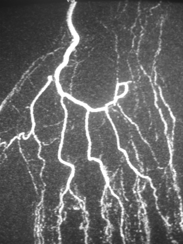 Figure 1. Angio-MRI showing the lack of permeability of the ulnar artery at the level of the tunnel of Guyon.