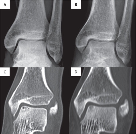 Figure 3. A 53-year-old man with OCL. (A) Initial standing radiograph and (C) CT. (B) Standing radiograph and (D) CT at 7-year follow-up. The lesion size decreased, and the AOFAS ankle–hindfoot score improved from 73 to 100.
