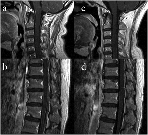 Figure 3. The MRI images at the initial time of LM diagnosis and after 2 months erlotinib given. The enhanced-contrast MRI showed an atypical thickness setuliform enhanced cervical and thoracic pia mater (a, b); after 2 months for erlotinib and bevacizumab administered, the degree of enhanced decreased and the thickness was thinner than the initial MRI image (c, d).