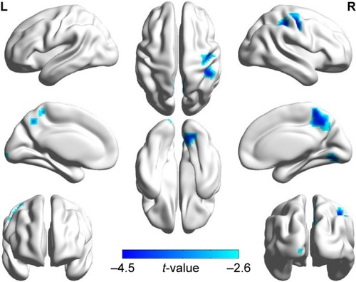 Figure 2 Significant abnormal activity map observed in the left occipital lobe, the right lingual, the bilateral precuneus, and the right precentral gyrus between patients with COPD and NCs (two-tailed, GRF correction, voxel-level P <0.01, and cluster-level P <0.05) in three-dimensional image.Abbreviations: GRF, Gaussian random field theory; NCs, normal controls.