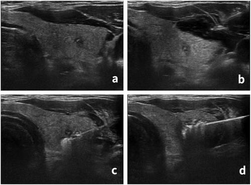 Figure 1. Microwave ablation process. (a) Nodule location was determined before ablation. A hypoechoic nodule, approximately 3 × 3 × 4 mm in size, was found in the left lobe of the thyroid with an unclear boundary and microcalcification inside. (b) The ‘liquid isolation zone’ was injected outside the capsule of the thyroid gland. (c) The ablation started from the lower pole of the nodule. (d) The ablation area was expanded until the nodules and their surrounding areas were completely covered by a hyperechoic area.