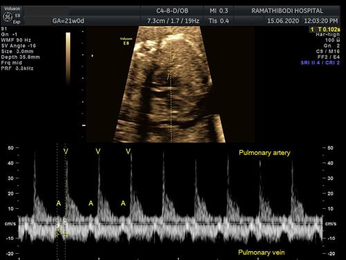Figure 3 Pulsed wave Doppler image of pulmonary artery–pulmonary vein (PA–PV) view obtained from four-chamber view, mechanical PR interval was measured between onset of pulmonary vein atrial wave and onset of pulmonary artery ejection flow.