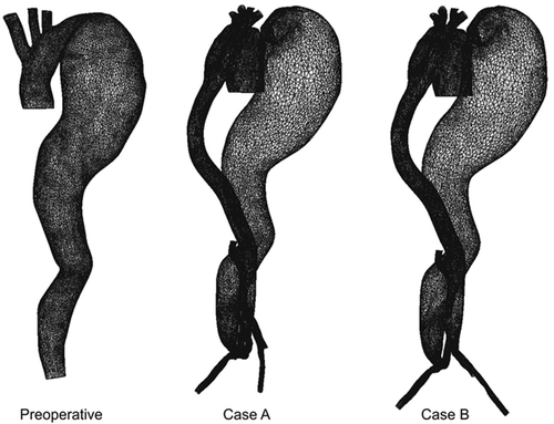 Figure 3. Finite element meshes for the preoperative case and the two postoperative cases A and B.