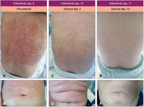Figure 4 Evolution of the skin rash during the differentiation syndrome (A-F).