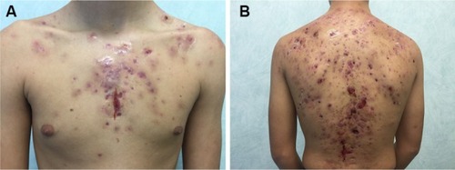 Figure 1 A few days after starting lymecycline for nodular acne of the trunk, a dramatic worsening of the clinical picture, with the occurrence of multiple, painful ulcerated nodules on the chest (A) and shoulders (B) associated with malaise and arthralgias, was observed.