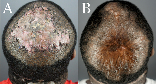 Figure 6 Patient 3: Preoperative FD plaque involving the entire vertex. (A) and eight months after complete excision of the FD lesion and healing by second-intention, aided by guarded high-tension sutures and a minor skin graft(B).