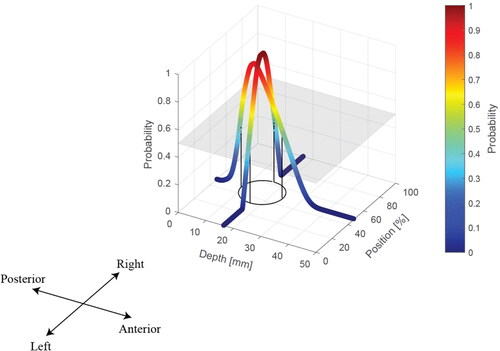 Figure A5. Step 5 –binary identification of PCa nodule using a probability threshold. The effect of the probability threshold is discussed in Electronic Supplementary Material (ESM). In this example the probability threshold was 0.5.