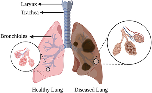 Figure 2 Diagram representing human lungs and their anatomy. On the left side of the diagram, a set of healthy lungs is shown while on the right side, a pair of diseased lung illustrates the effects of lung disease. Created with Biorender.com.