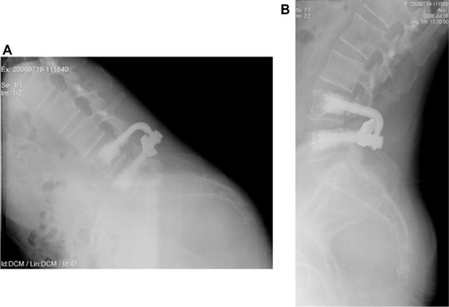 Figure 7 Lumbar X-rays of the same case with the new implant in place.