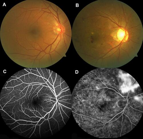 Figure 1 Examples of retinal fundus photography and fluorescence fundus angiography in the DR patients and HC group.