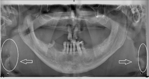 Figure 1 A panoramic radiograph of a 76-year-old female. There were bilateral multiple radiopacities of suspected calcified carotid atheromas (white circles) (Group A, study group).