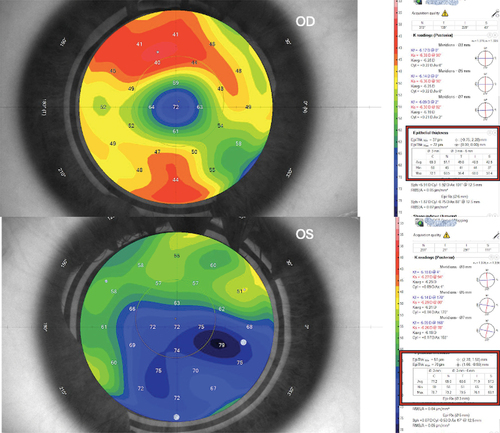 Figure 2. 1-week postoperative epithelial thickness map in both eyes for the same case. The associated table divides the measurement to central 3mm (C) and paracentral nasal (N), temporal (T), inferior (I), and superior (S) 3–6mm annulus. mPRK-treated eye shows increased central and paracentral epithelial thickness than tPRK-treated eye.