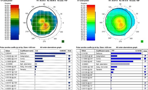 Figure 5 Preoperative and post-HRWG PRK + CXL corneal topography axial power map and polar Zernike coefficients, as recorded by iDesign software (iDesign, Abbott Medical Optics, Inc., Santa Ana, CA, USA) in one of the keratoconus™ eyes.
