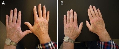 Figure 2 (A) Recalcitrant psoriasis on the backs of hands in a 78-year-old male before treatment with Cal/BD aerosol foam. (B) Psoriatic lesions after 4 weeks’ treatment with Cal/BD aerosol foam.