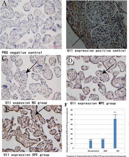 Figure 1. Expressions of UII in placental tissue by Immunochemistry. Expressions of UII and in SPE group were highly increased and were mainly located in the cytoplasm of placental trophoblastic cells and syncytiotrophoblast cells (brown deposits), A for PBS solution replace antibody as a negative control; B for positive control (human kidney tissue);C for normal pregnancy; D for MPE group and E for SPE group. There was significantly higher integral optical density (IOD) of UII expression in placenta in SPE in comparison with normal control by semi-quantitative analysis，**P<0.01 Vs. Normal control ( F ).