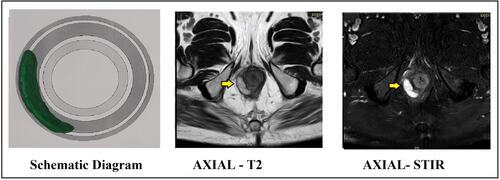 Figure 6 Abscess in right outer-sphincteric space from 9 to 7 o’clock. (external sphincter muscle cannot be seen lateral to the abscess and the abscess is juxtaposed to the fat in ischiorectal fossa). Abscess indicated by yellow arrows. Left panel: Schematic diagram. Middle panel: MRI axial section T-2 sequence. Right panel: MRI axial section STIR sequence.