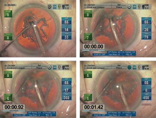 Figure 6 Soft cataract technique using the Epinucleus Removal Setting.