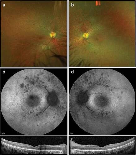 Figure 2. Retinal imaging studies for Case 1: (a, b) colour photographs of right and left fundi demonstrating attenuated vessels and waxy disc pallor but not capturing sparse bone spicule pigmentations; (c, d) widefield FAF imaging (55 degrees) demonstrating patchy autofluorescence in the nasal midperiphery and along the supero-temporal arcades; (e, f) OCT imaging showing extensive photoreceptor loss and outer retinal degeneration, with a partially preserved foveal ellipsoid zone.