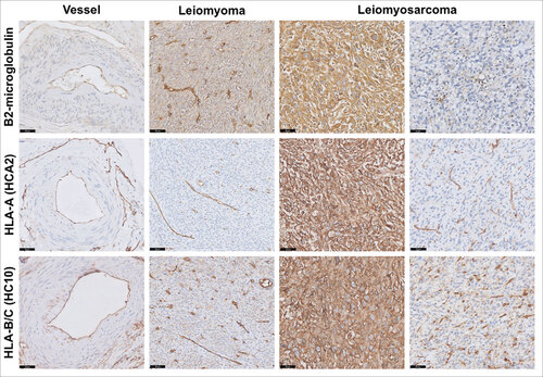 Figure 3. HLA class I expression in leiomyosarcoma. Representative staining patterns of β2-microglobulin, HLA-A (HCA2 antibody) and HLA-B/C (HC10 antibody) expression in smooth muscle cells from blood vessel, leiomyoma and leiomyosarcoma using immunohistochemistry. In general, basal low HLA class I expression was found on normal smooth muscle cells while frequently heterogeneous or strongly positive expression was seen in leiomyosarcomas, suggesting that HLA class I is upregulated in the majority of these tumors. Scale bars, 50 μm.