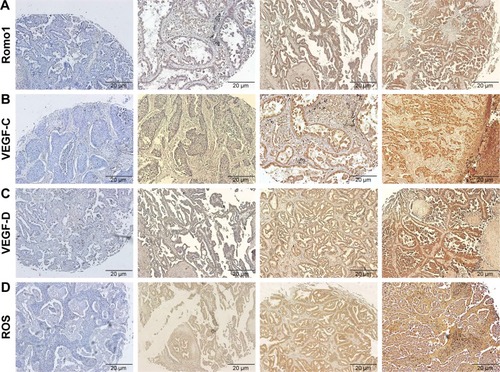 Figure 1 Representative IHC-stained tissue samples. Magnification, ×100; (A) Romo1, negative control, IHC score of 2, 10, and 15; (B) VEGF-C, negative control, IHC score of 2, 9, and 15; (C) VEGF-D, negative control, IHC score of 2, 8, and 15; (D) ROS, negative control, IHC score of 1, 7, and 15.