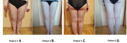 Figure 3 Lower limb photos of patient (no. 3) with lipedema before and after the LCHF diet. (A and C) - photos before intervention; (B and D) - photos after intervention (own documentation).